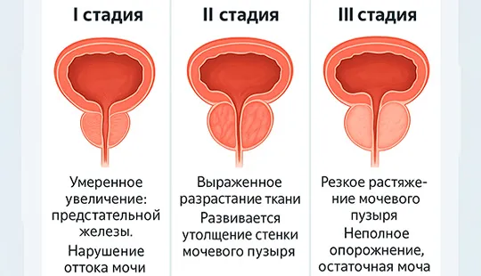 Классификация и стадии развития ДГПЖ